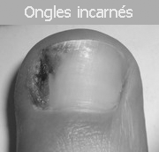 ongles-incarnes